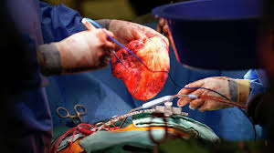 heart transplant
