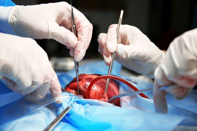 heart transplant