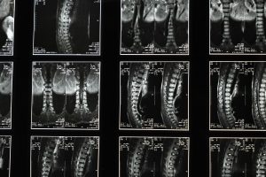 x-ray