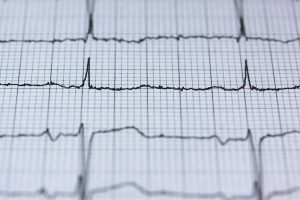 ECG
