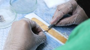Hair transplant