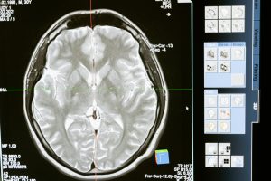Brain tumor
