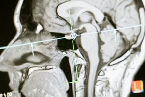 Brain tumor